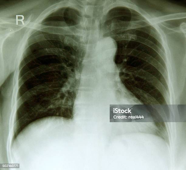 Photo libre de droit de Xray Image De La Poitrine banque d'images et plus d'images libres de droit de Cage thoracique - Cage thoracique, Cavité thoracique, Clavicule