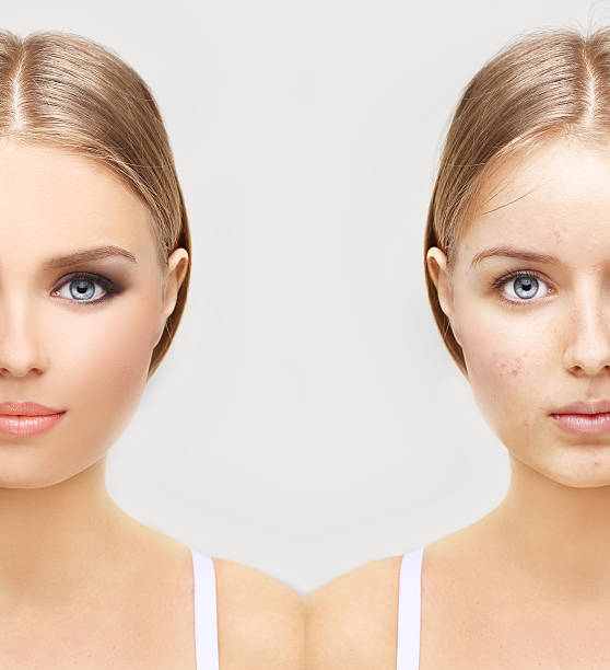 istock Girl without  make-up and one  with makeup 502318674