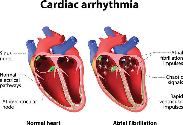 Vector illustration of Cardiac arrhythmia