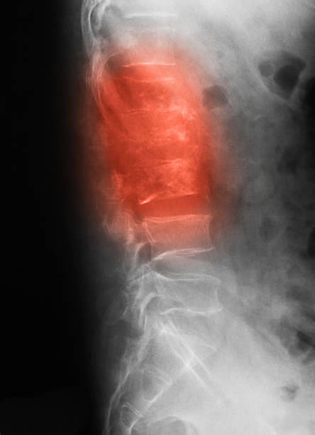 x 線画像の l-s 脊椎、ラテラルの眺めをご覧いただけます。 - pain rib cage x ray image chest ストックフォトと画像