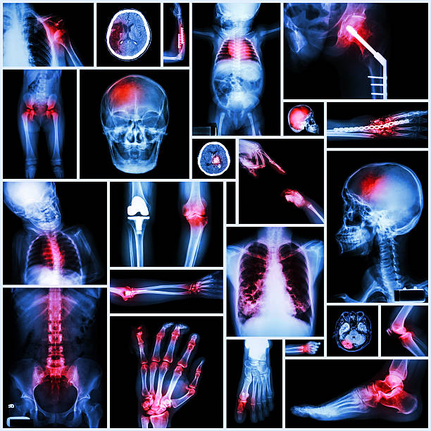 Collection X-ray part of human,Orthopedic operation,Multiple disease Collection X-ray part of human,Orthopedic operation,Multiple disease (Fracture,Gout,Rheumatoid arthritis,Osteoarthritis knee,Stroke,Brain tumor,etc.) hip joint x stock pictures, royalty-free photos & images