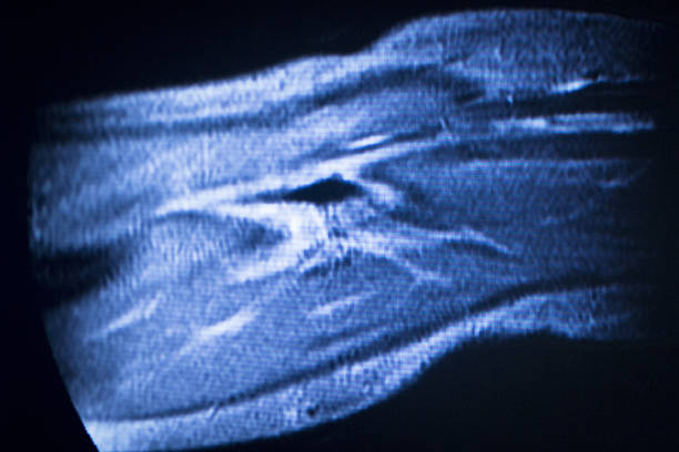 istock MRI magnetic resonance imaging elbow arm scan 502395274