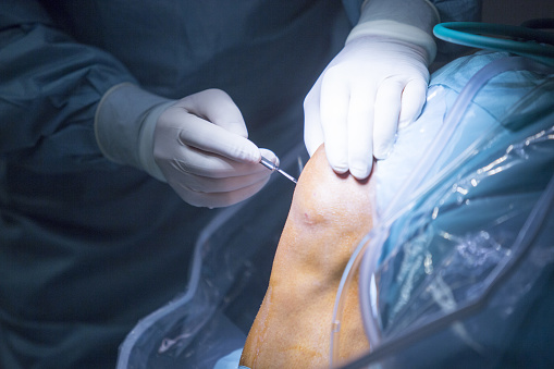 Traumatology cirugía ortopédica rodilla artroscopia por goteo de photo