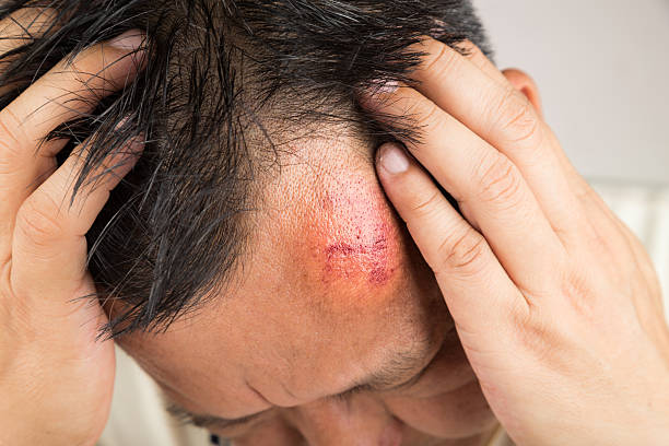 istock Selective focus  on painful red swollen forehead injury 502458032
