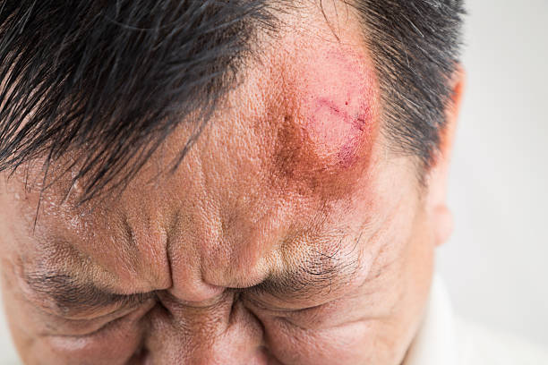 Selective focus  on painful red swollen forehead injury Selective focus on painful red swollen forehead of man injured from accidental fall bumpy photos stock pictures, royalty-free photos & images