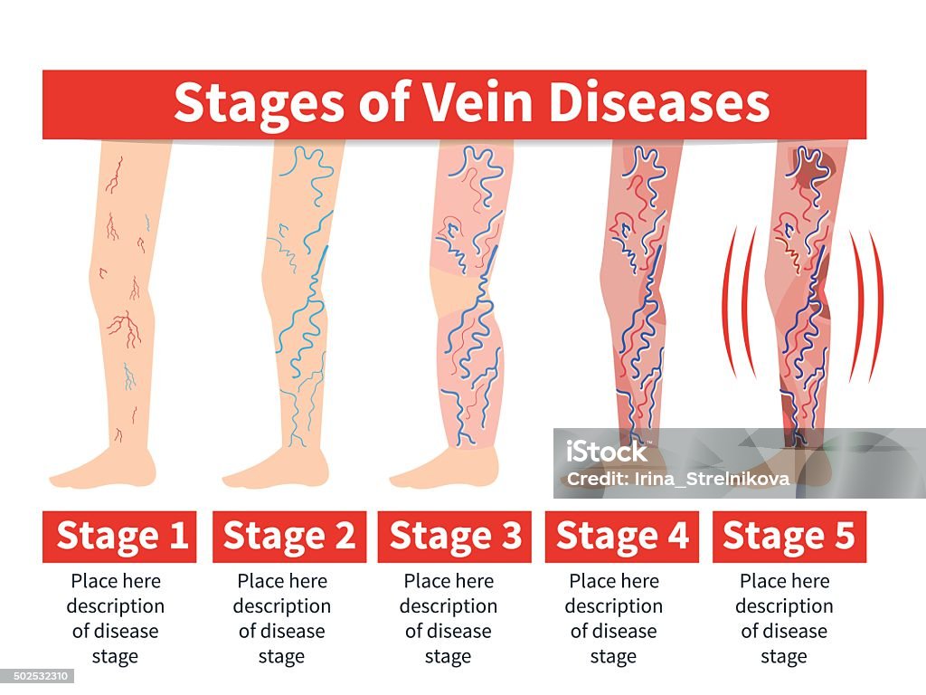 Varicose Infografik - Lizenzfrei Krampfader Vektorgrafik