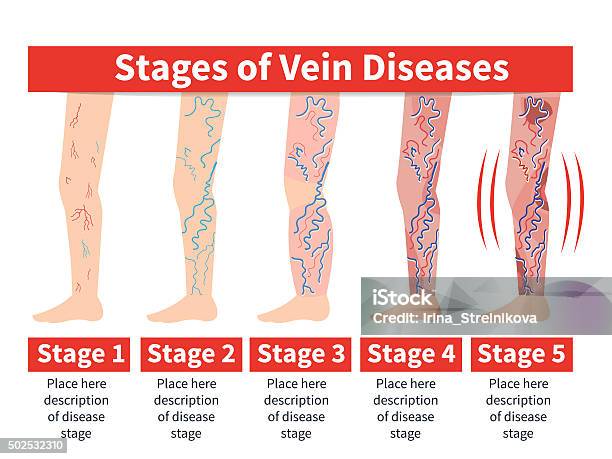 Varicose Infografik Stock Vektor Art und mehr Bilder von Krampfader - Krampfader, Informationsgrafik, Krankheit