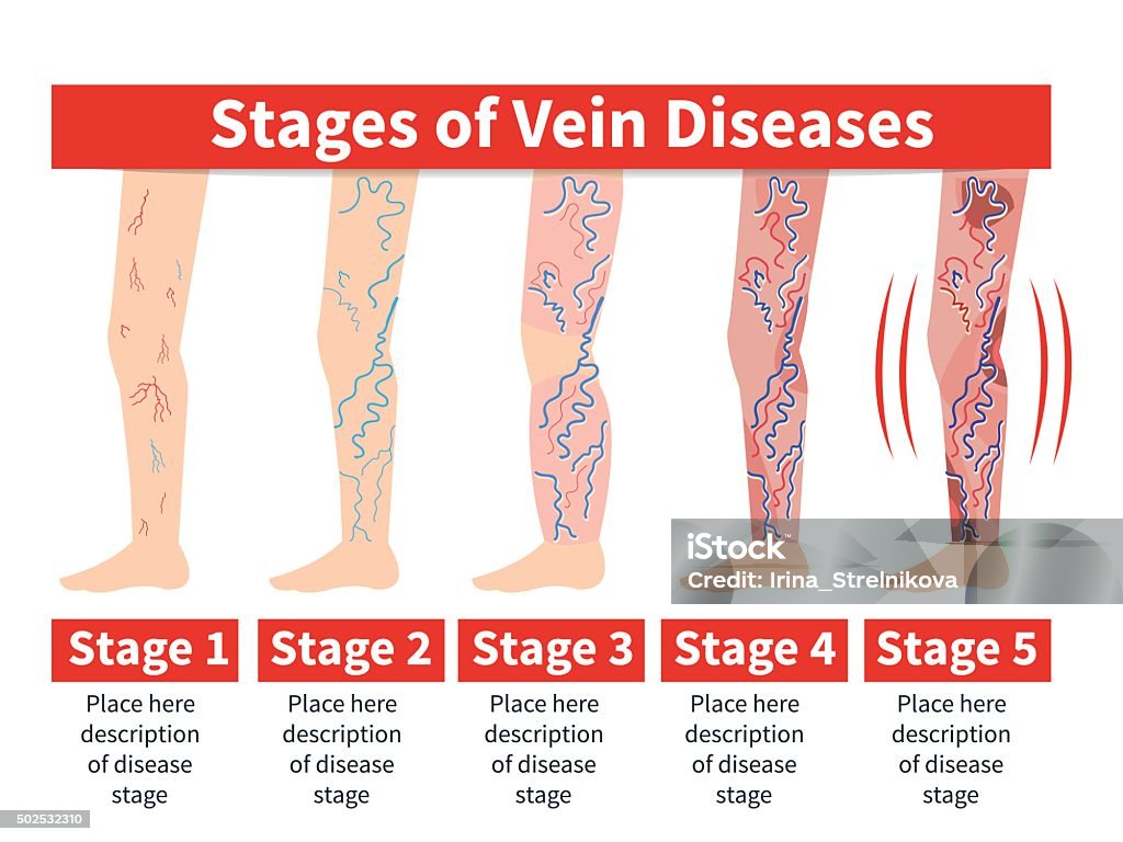 Varicose infographic Vector Varicose infographic. Stage of vein diseases. Medical infographic. Varicose Vein stock vector