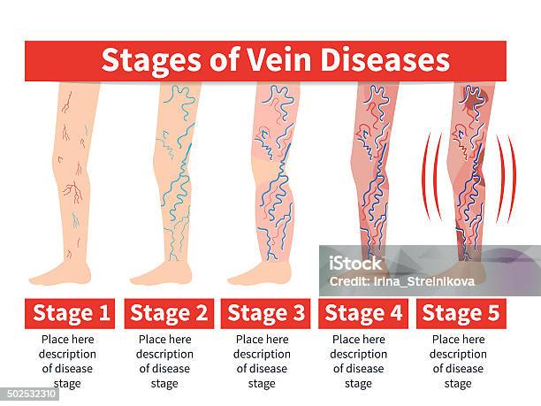 Varicose Infographic Stock Illustration - Download Image Now - Varicose Vein, Illness, Infographic