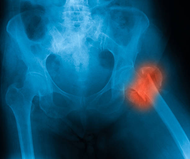 image au rayon x de la hanche, avec règlement à l'avance. - hip femur ilium pelvis photos et images de collection