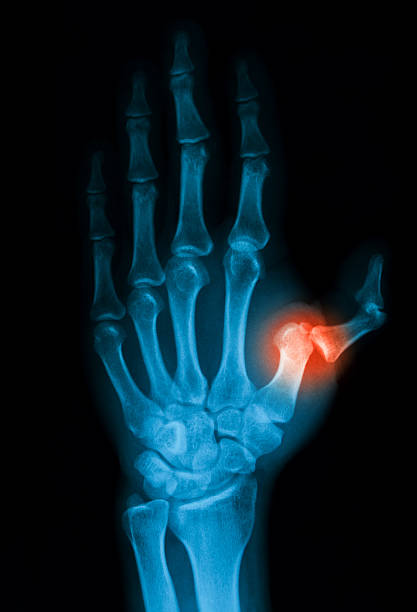 istock X-ray image of hand, PA view. 502640376
