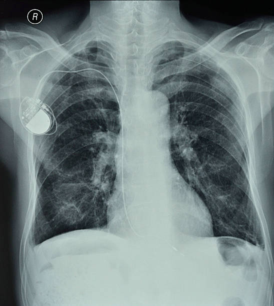 istock X-ray chest photos 502643554