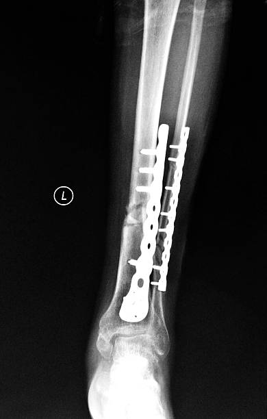 istock Left tibiofibula X-ray pictures 502643920