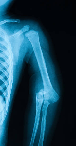 image au rayon x de coude montrant fractures et dislocation de coude. - x ray x ray image shoulder human arm photos et images de collection