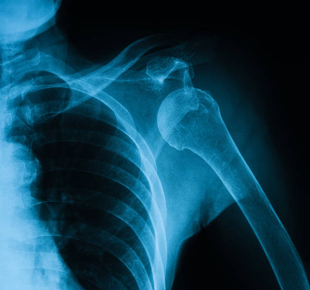 istock X-ray image of shoulder, AP view. 502670372