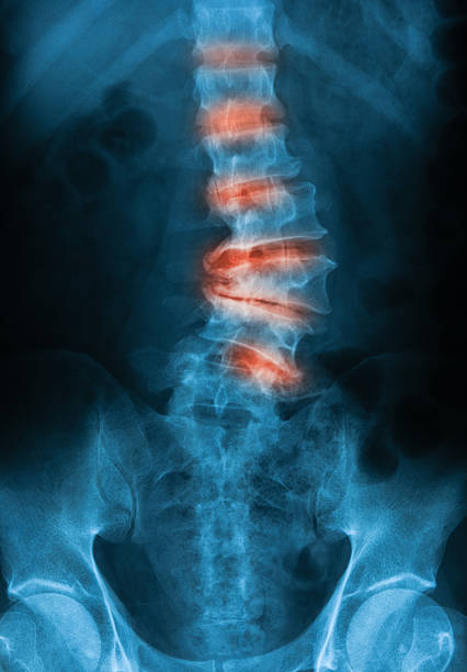 x 線画像の lumbo -仙骨脊椎を変形性関節症の腰椎。 - pain rib cage x ray image chest ストックフォトと画像