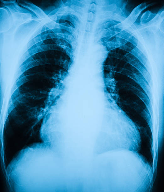 胸 x 線画像の心臓病 - pain rib cage x ray image chest ストックフォトと画像