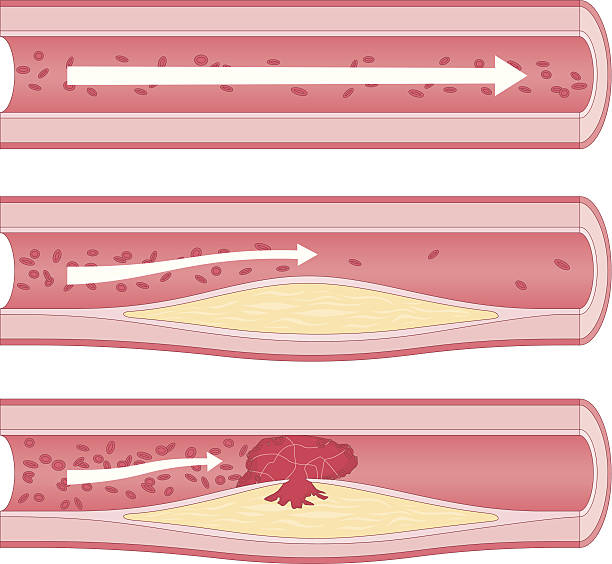 illustrations, cliparts, dessins animés et icônes de athérosclérose - bloodstream