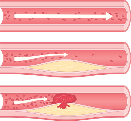 Medical diagram showing stages of atherosclerosis; a condition where the arteries become narrowed and hardened due to excessive build up of plaque around the artery wall.