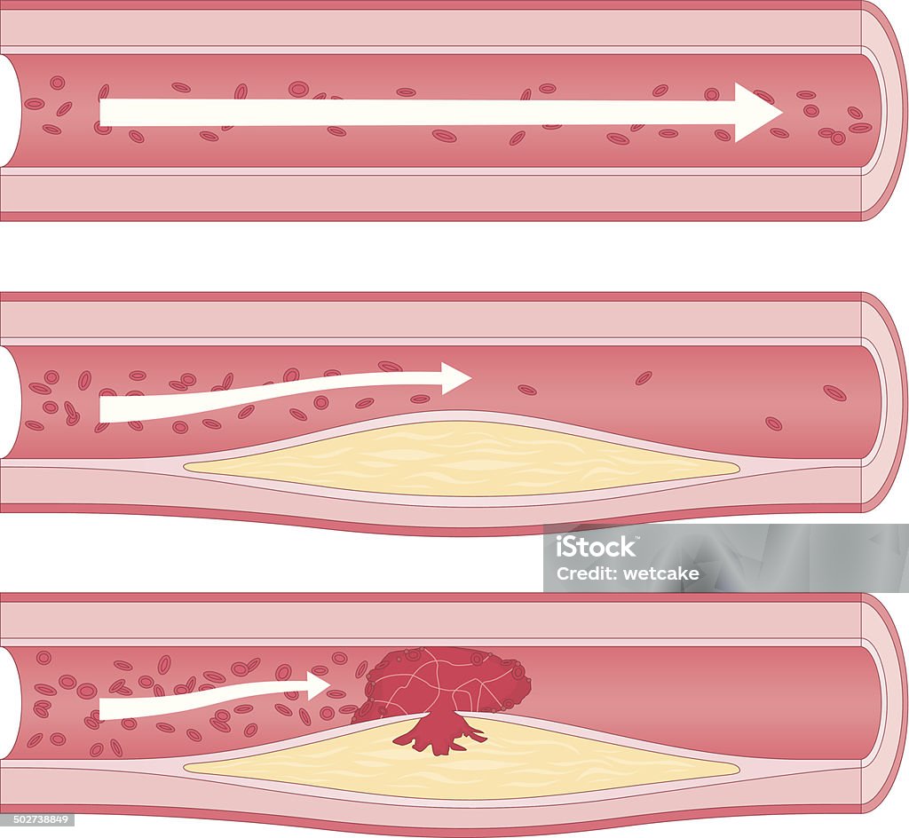 Atherosclerosis Medical diagram showing stages of atherosclerosis; a condition where the arteries become narrowed and hardened due to excessive build up of plaque around the artery wall. Blood Vessel stock vector