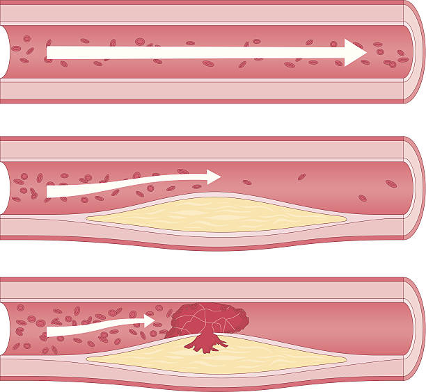 Atherosclerosis Medical diagram showing stages of atherosclerosis; a condition where the arteries become narrowed and hardened due to excessive build up of plaque around the artery wall. human artery stock illustrations