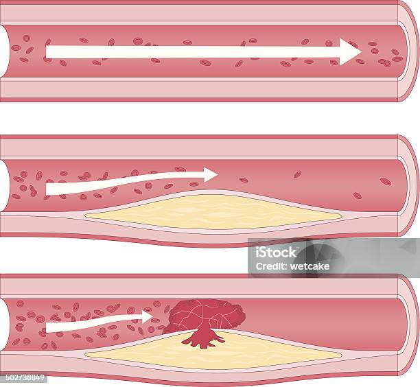 Atherosclerosis Stock Illustration - Download Image Now - Blood Vessel, Blood Clot, Cholesterol