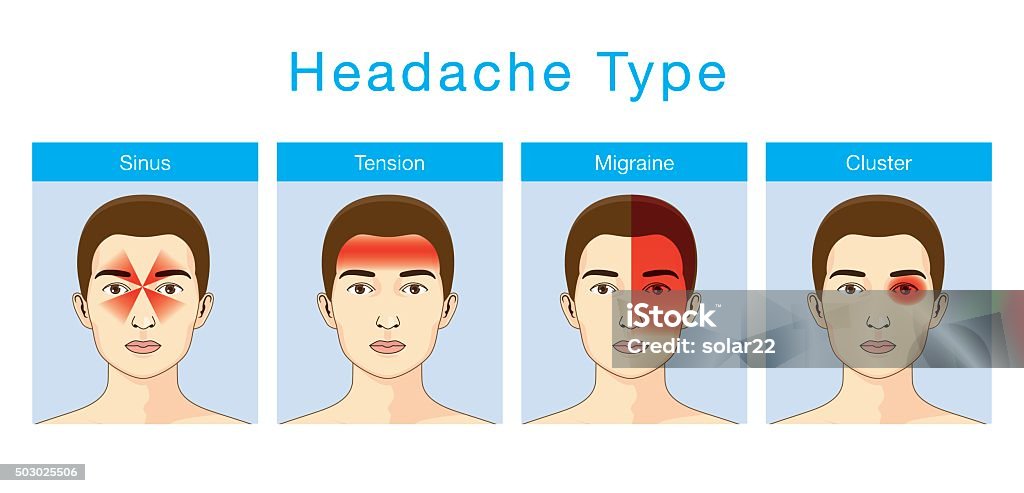Type of headache Illustration about headaches 4 type on different area of patient head. Headache stock vector