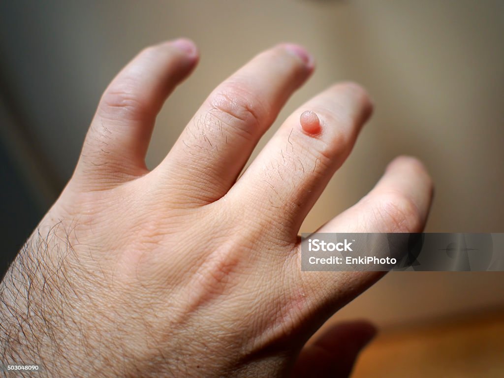 Wart on the hand Wart on the hand finger. Open hand. Wart Stock Photo