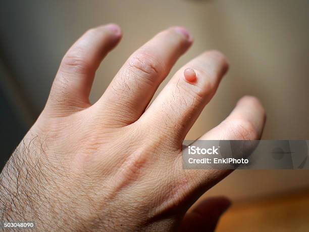 Wart On The Hand Stock Photo - Download Image Now - Wart, Backgrounds, Close-up