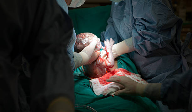 cesarean stock photo