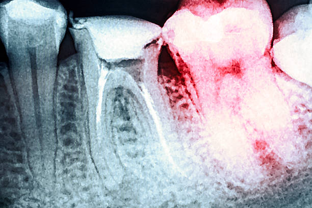 istock Pain Of Tooth Decay On X-Ray 503393562