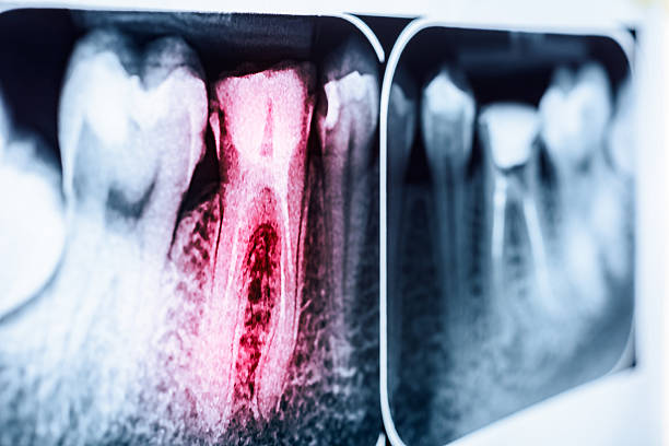 dor de dente decomposição de raios x - radiogram photographic image - fotografias e filmes do acervo