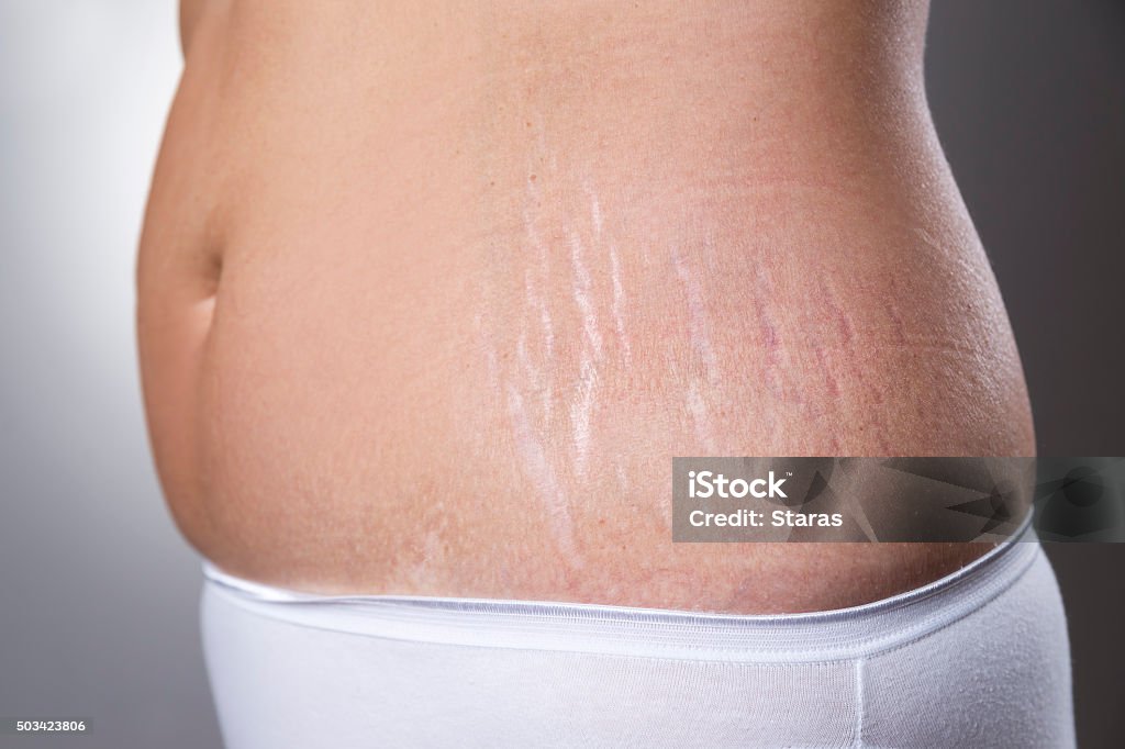 Female belly with pregnancy stretch marks closeup Female belly with pregnancy stretch marks closeup on a gray background Stretch Mark Stock Photo