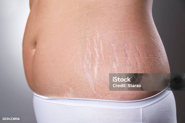 Female Belly With Pregnancy Stretch Marks Closeup Stock Photo - Download Image Now - Stretch Mark, Pregnant, One Woman Only