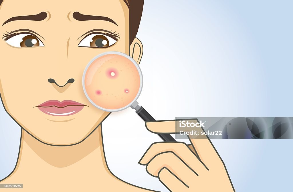 Finding acne with magnifier A magnifier on hand magnifying the woman facial to finding acne on her face area. She have feeling stress because acne. Acne stock vector