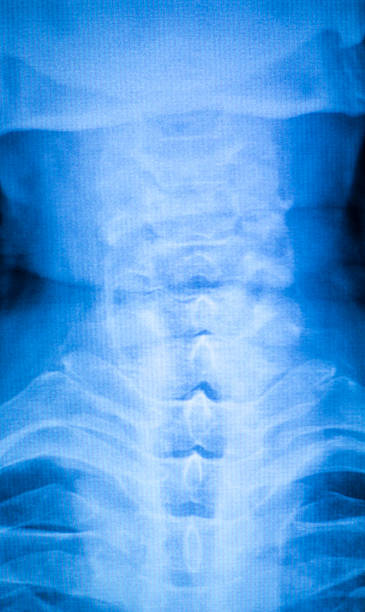 kneck y lesión en la columna, barrido de rayos x - human vertebra fotos fotografías e im�ágenes de stock