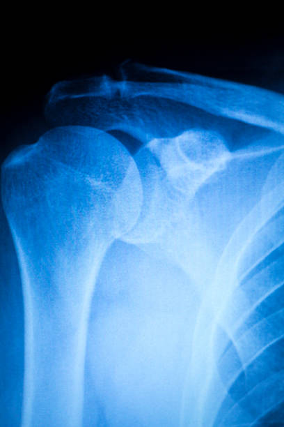 istock Shoulder injury orthopedics xray scan 503588154