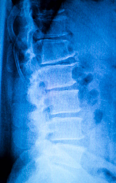 kneck e spina dorsale per lesioni x-ray scansione - vertebral body foto e immagini stock