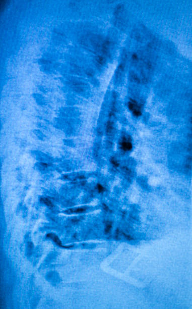 kneck e spina dorsale per lesioni x-ray scansione - vertebral body foto e immagini stock
