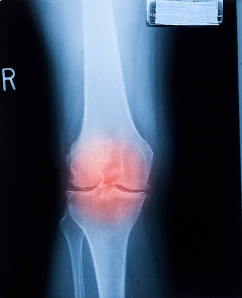 cheville carrés & les douleurs articulaires du genou humain x-ray du film à résonance magnétique - human joint human knee pain x ray photos et images de collection