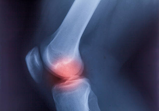 cheville carrés & les douleurs articulaires du genou humain x-ray du film à résonance magnétique - human joint human knee pain x ray photos et images de collection
