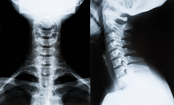 X-ray image of neck X-ray image of neck cervical spine isolated on black background cervical vertebrae photos stock pictures, royalty-free photos & images