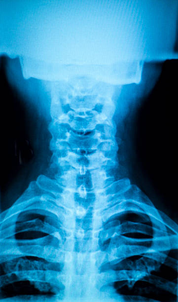 kneck e spina dorsale per lesioni x-ray scansione - vertebral body foto e immagini stock
