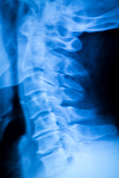 kneck y lesión en la columna, barrido de rayos x - human vertebra fotos fotografías e imágenes de stock