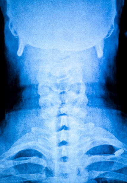 kneck y lesión en la columna, barrido de rayos x - human vertebra fotos fotografías e imágenes de stock