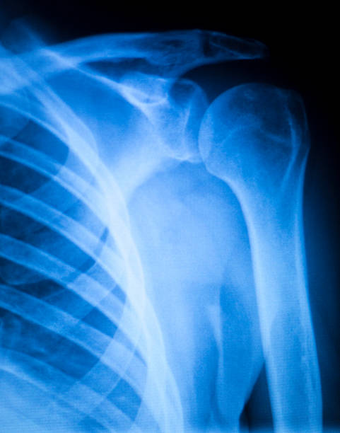 istock Shoulder injury orthopedics xray scan 503761810