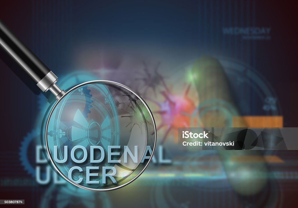 duodenal ulcer hi tech infographics of duodenal ulcer made in 3d software Abdomen Stock Photo