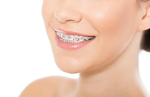 Photo of Beautiful young woman wearing braces