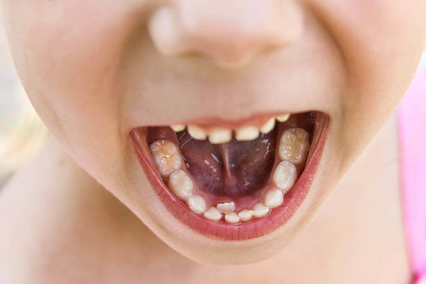 istock Baby tooth is still not dropped, the next grew root tooth 503943967