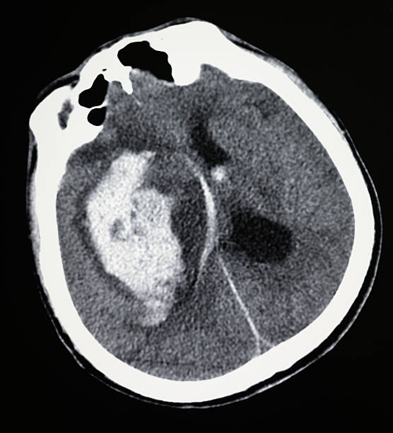 istock meningioma showing on head  CT image 504101591